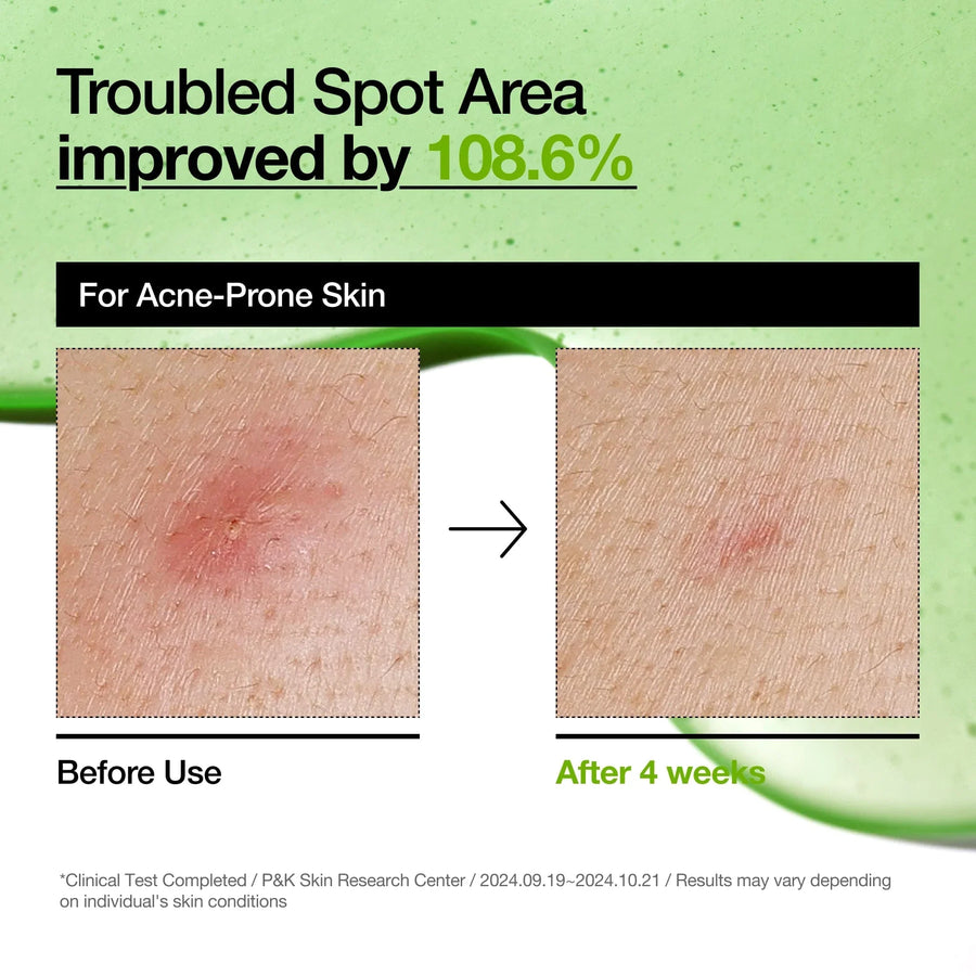 Anua Azelaic Acid 10+ Hyaluron Soothing Serum - 30ml